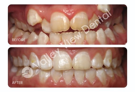 Affordable orthodontics in Montgomery, IL - teeth transformation, two sets of teeth before and after braces treatment