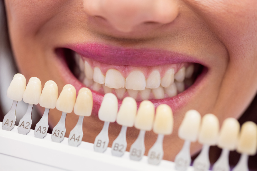 A close-up of a patient smiling at Valley View Dental while a professional teeth whitening shade guide is used to compare and select the perfect bright shade for their smile.