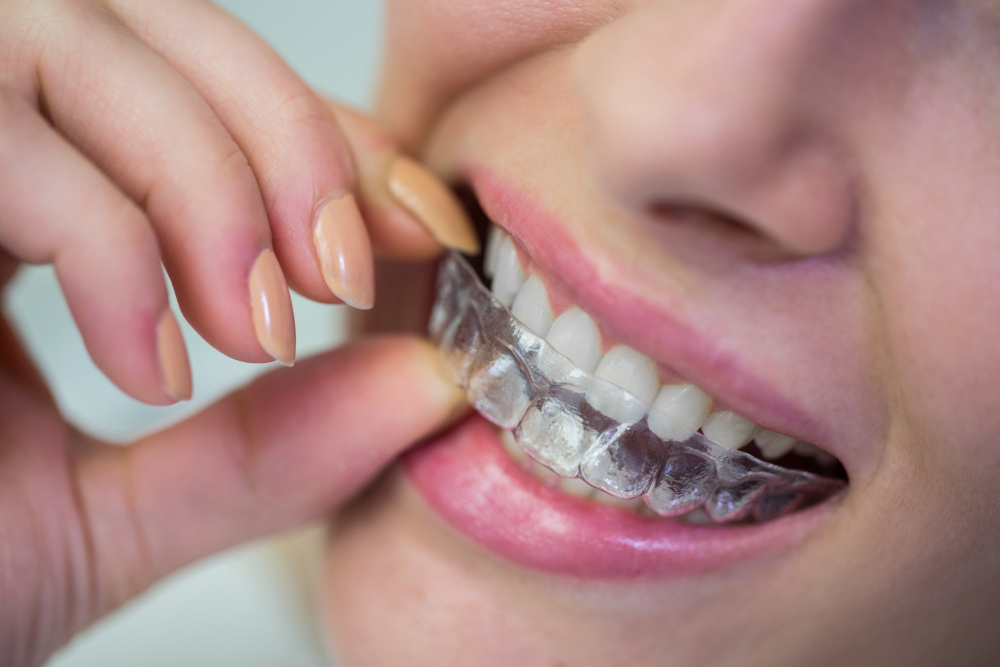 Night Guards - Valley View Dental