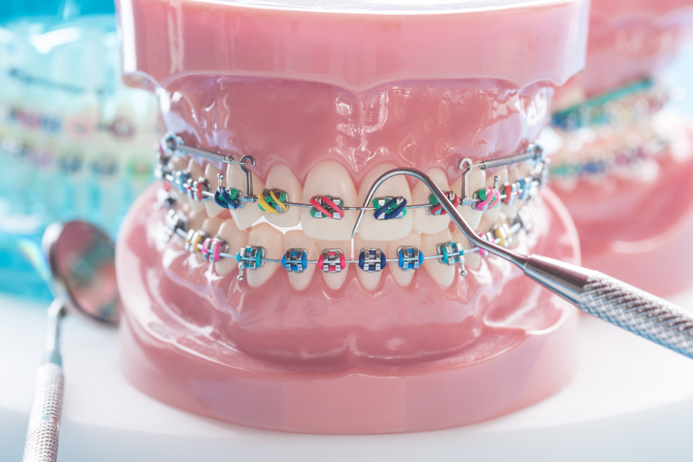 Orthodonist Near Me in Naperville, IL, teeth set model with traditional braces and dental instruments