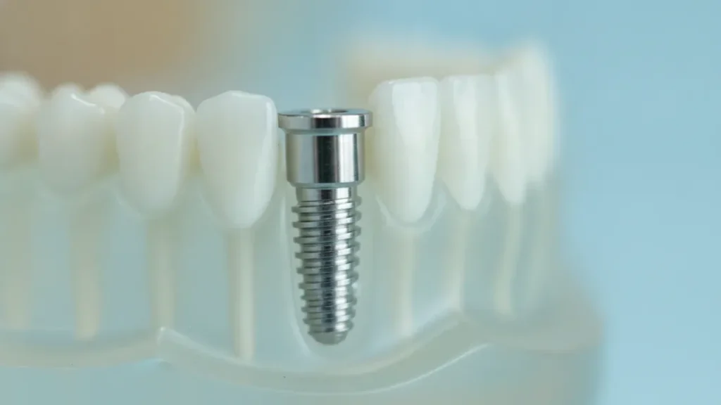 CONTENT A017 dentalimplantprocess inbetween 1 - Valley View Dental